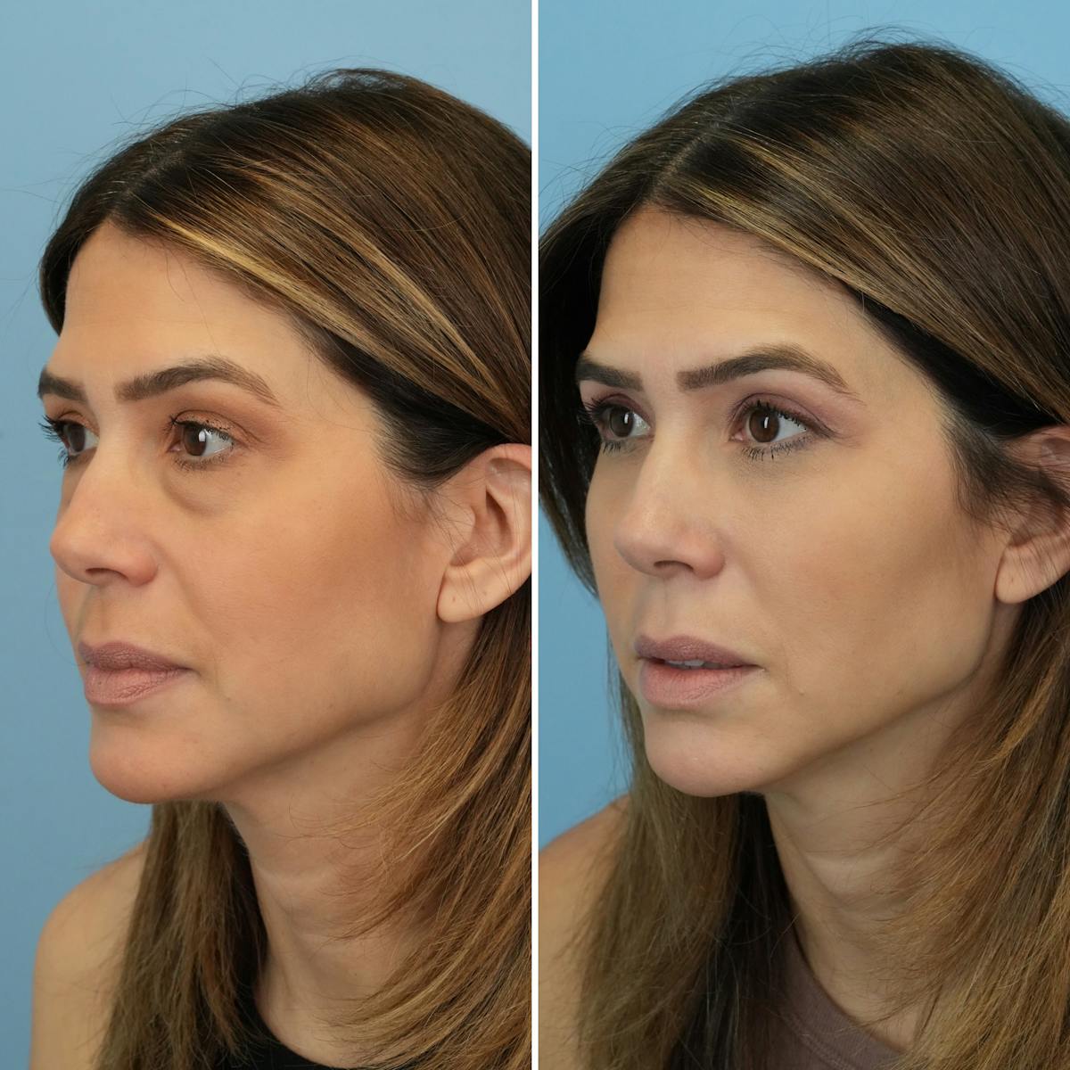 Blepharoplasty Before & After Gallery - Patient 841823 - Image 8