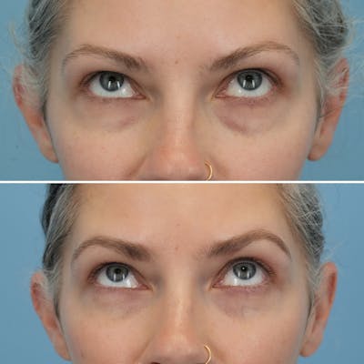 Blepharoplasty Before & After Gallery - Patient 150794 - Image 1