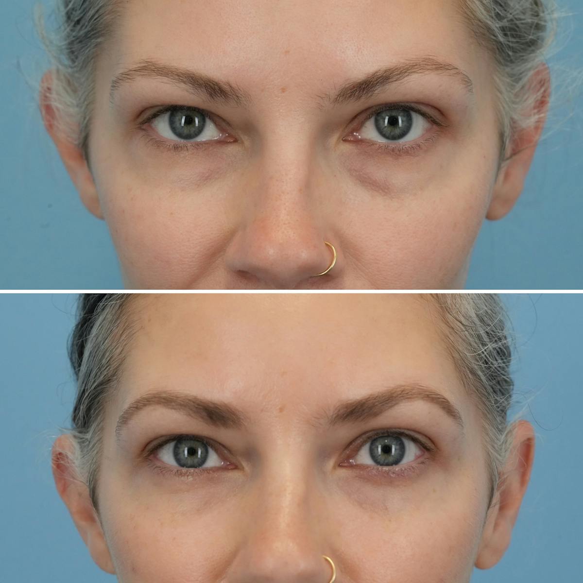 Blepharoplasty Before & After Gallery - Patient 150794 - Image 2