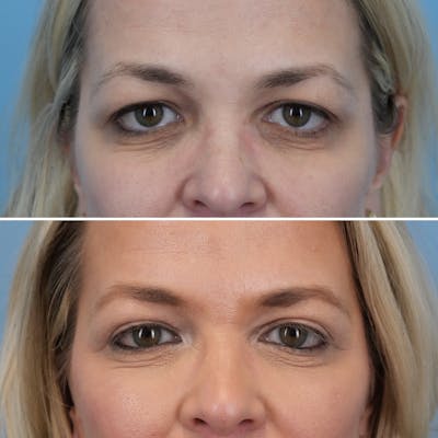 Blepharoplasty Before & After Gallery - Patient 232173 - Image 1