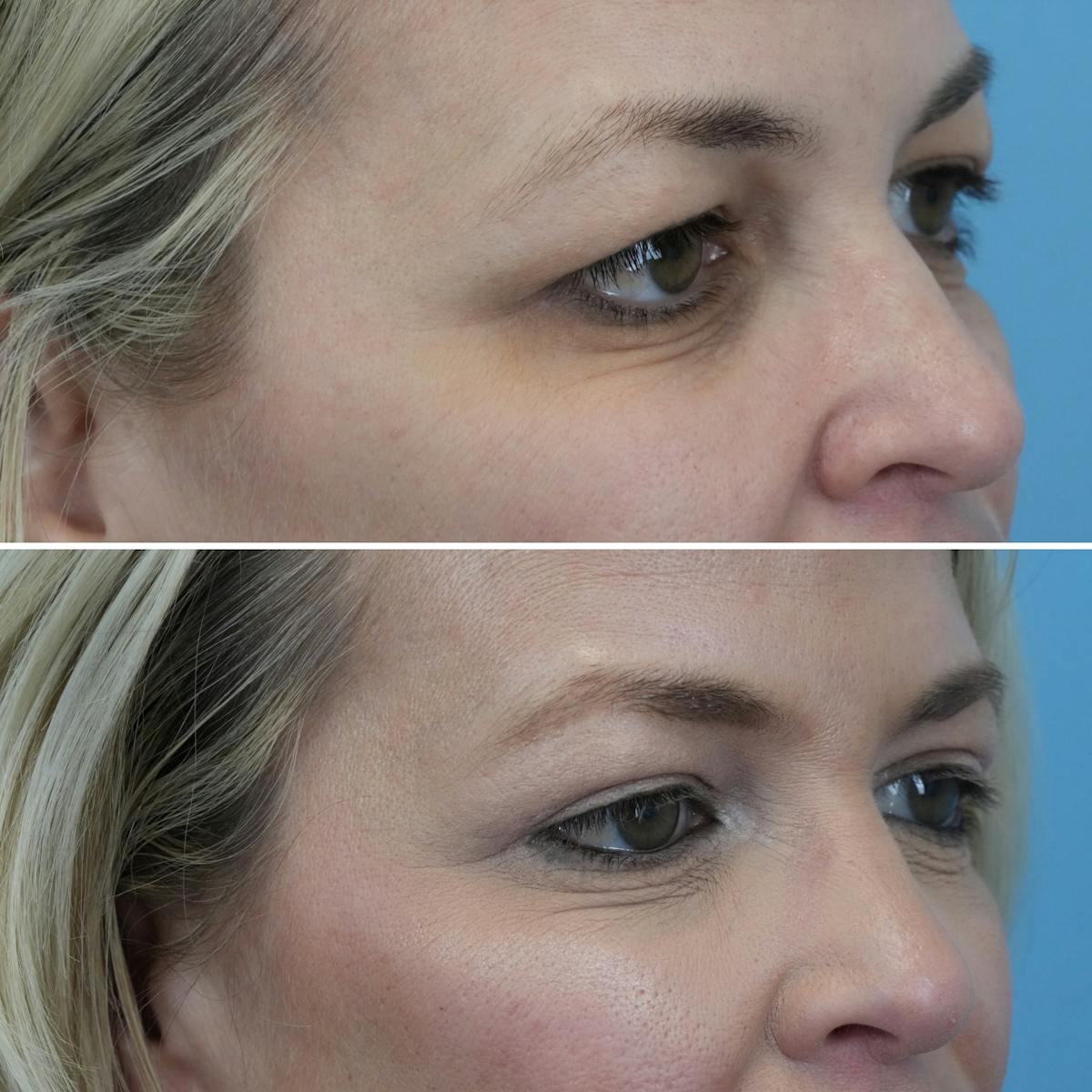 Blepharoplasty Before & After Gallery - Patient 232173 - Image 2