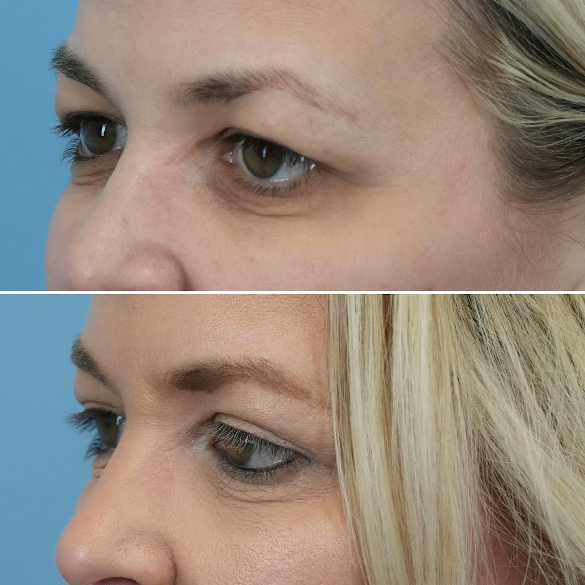 Blepharoplasty Before & After Gallery - Patient 232173 - Image 3