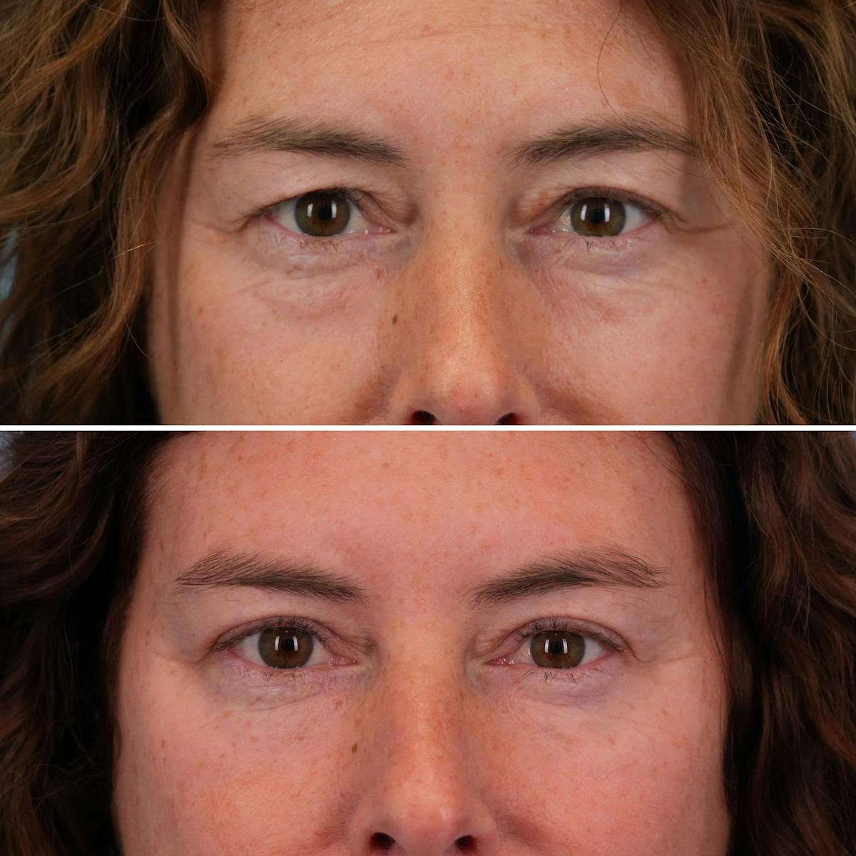Blepharoplasty Before & After Gallery - Patient 575573 - Image 1