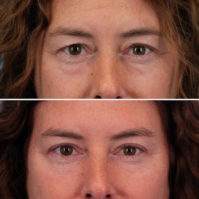 Blepharoplasty Before & After Gallery - Patient 575573 - Image 1