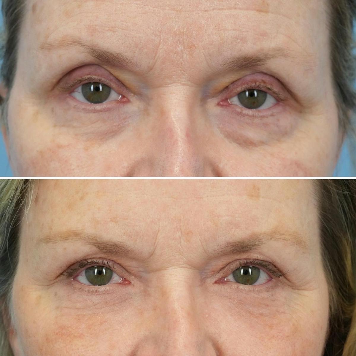 Blepharoplasty Before & After Gallery - Patient 208699 - Image 1