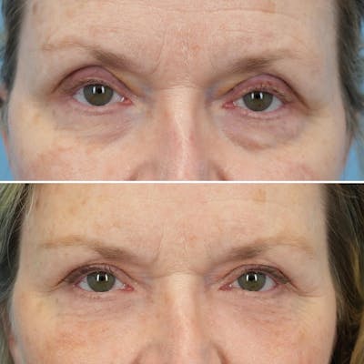 Blepharoplasty Before & After Gallery - Patient 208699 - Image 1