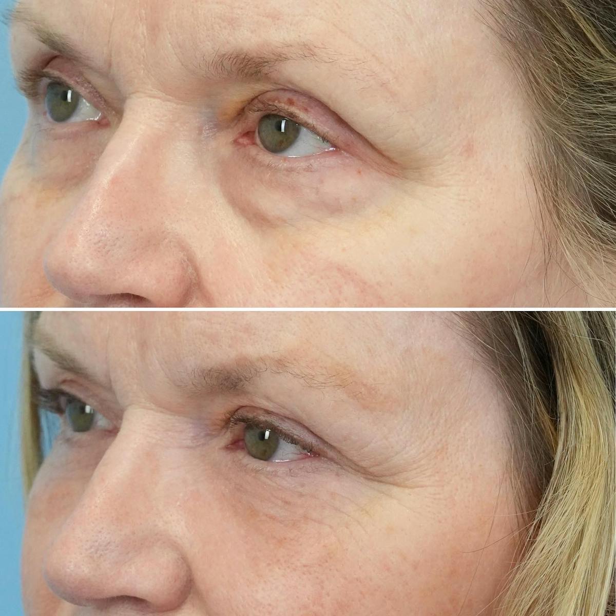 Blepharoplasty Before & After Gallery - Patient 208699 - Image 2
