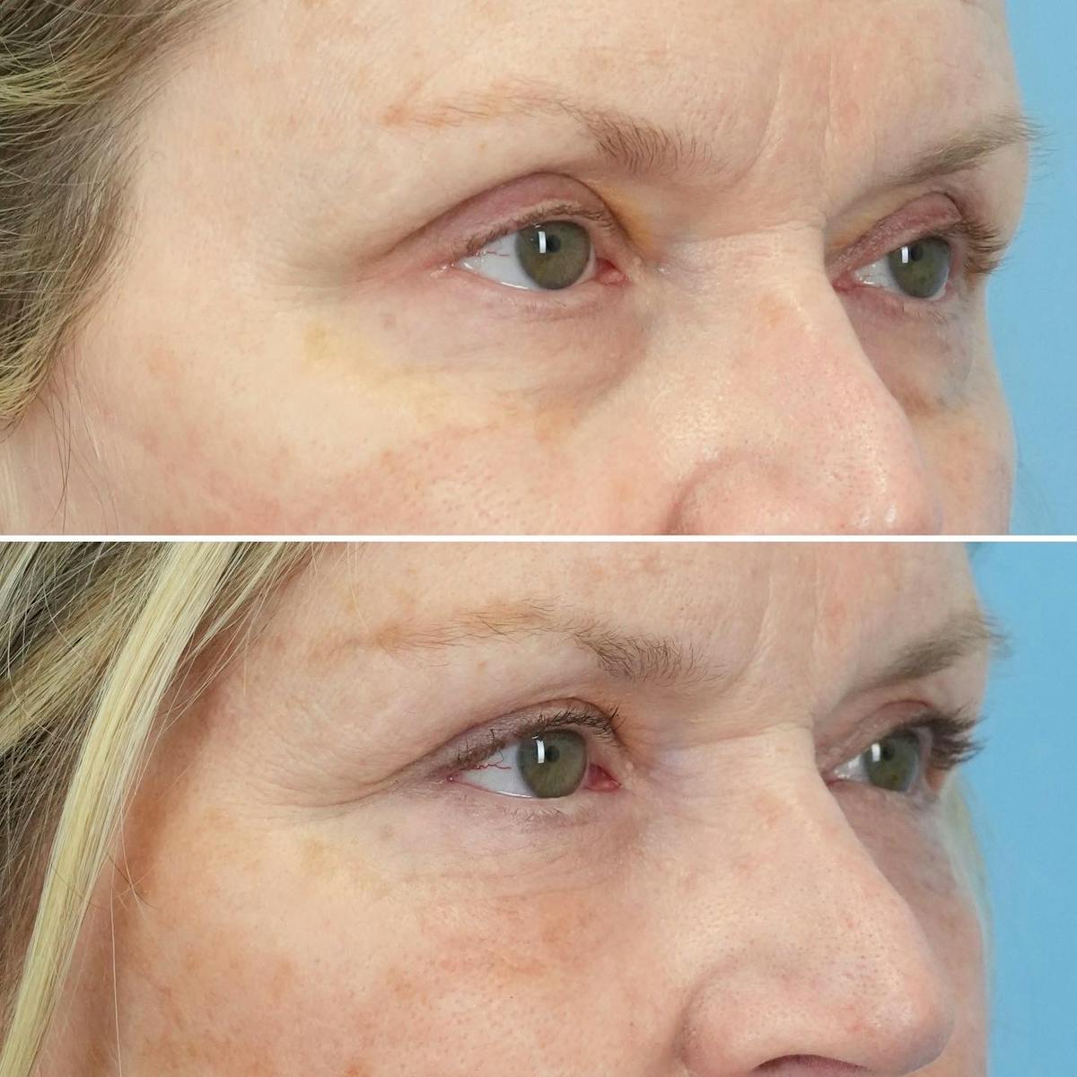 Blepharoplasty Before & After Gallery - Patient 208699 - Image 3