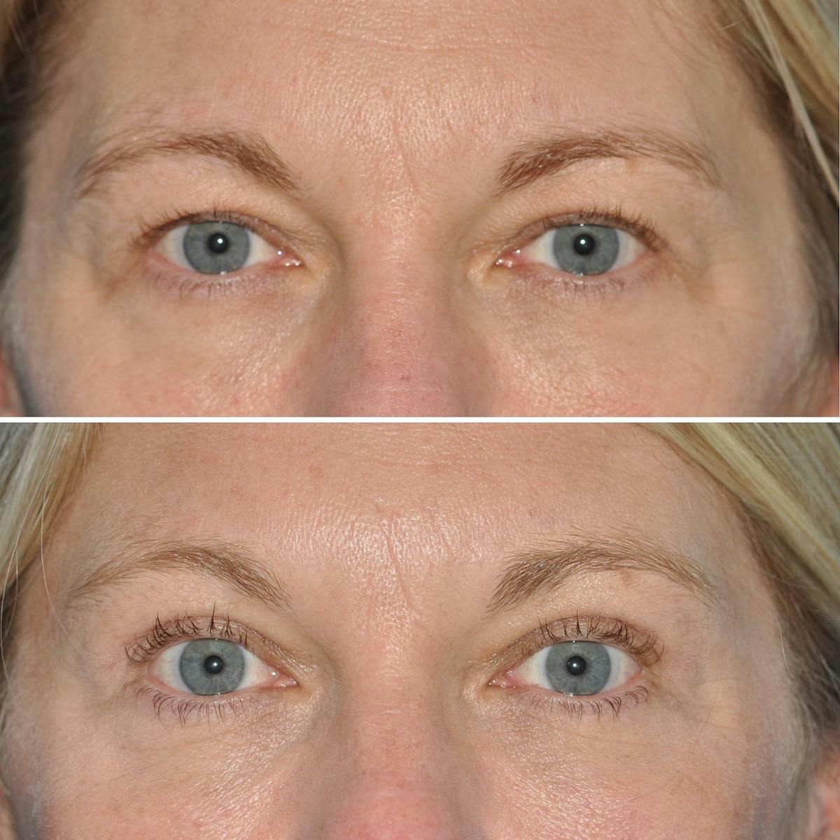 Blepharoplasty Before & After Gallery - Patient 301815 - Image 1