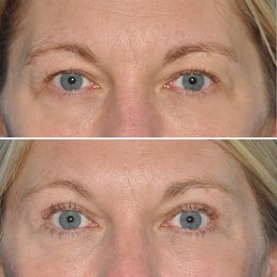 Blepharoplasty Before & After Gallery - Patient 301815 - Image 1