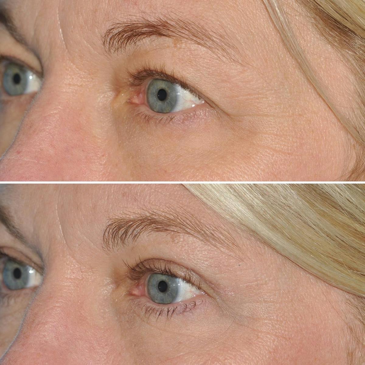 Blepharoplasty Before & After Gallery - Patient 301815 - Image 4