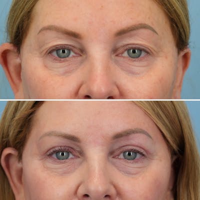 Blepharoplasty Before & After Gallery - Patient 214937 - Image 1
