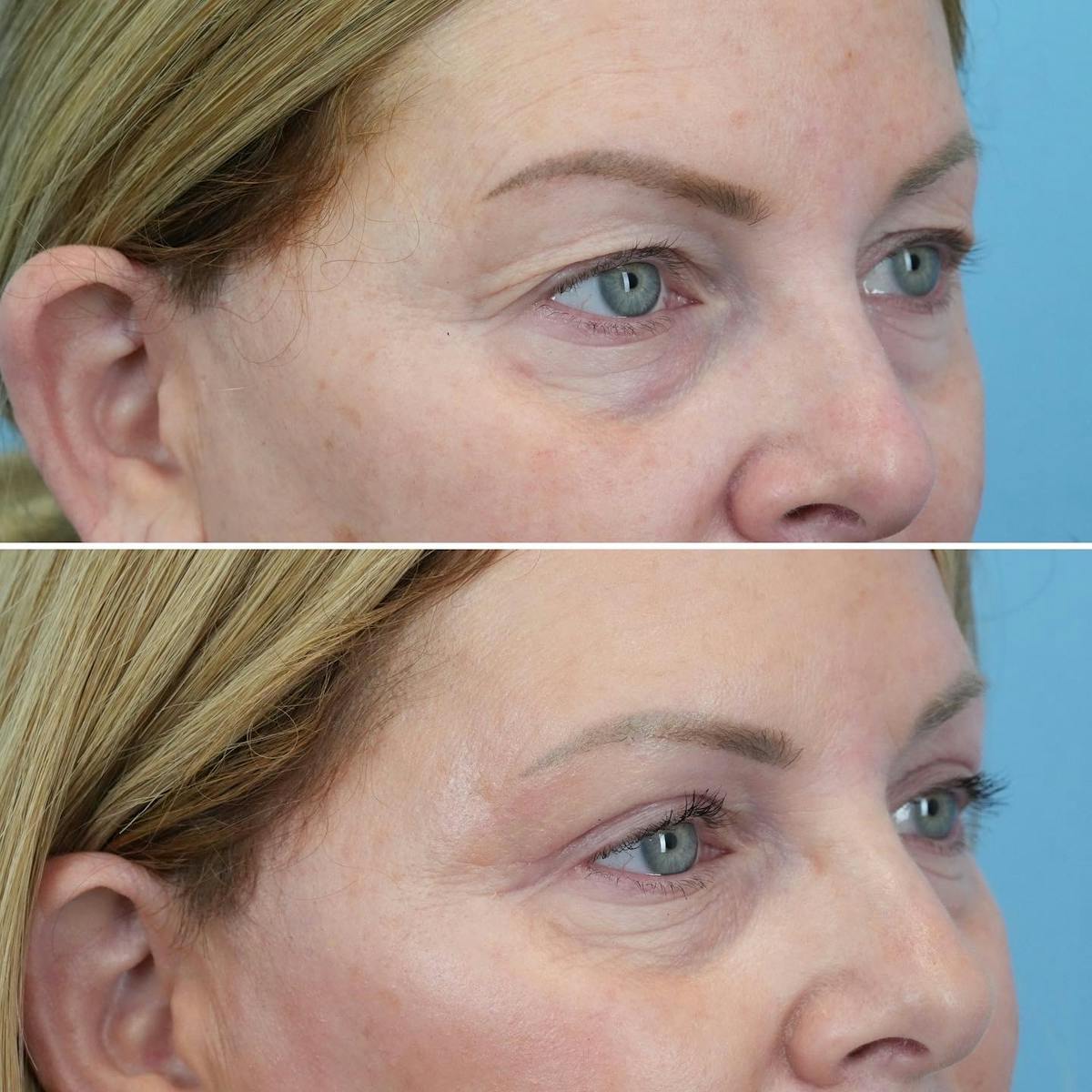 Blepharoplasty Before & After Gallery - Patient 214937 - Image 2