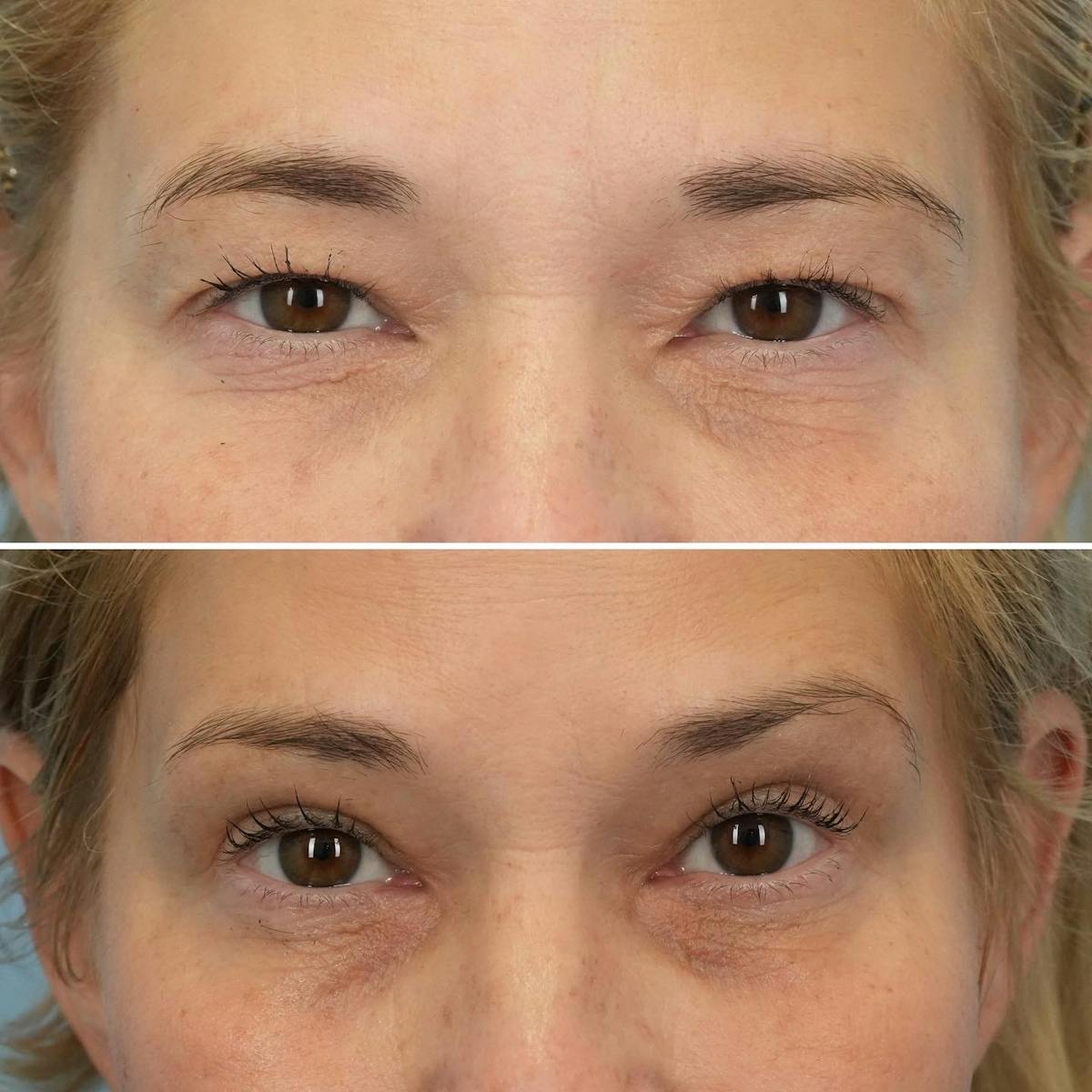 Blepharoplasty Before & After Gallery - Patient 259917 - Image 1