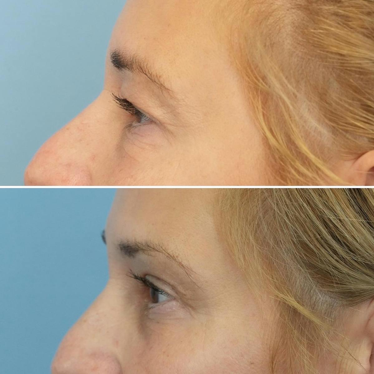 Blepharoplasty Before & After Gallery - Patient 259917 - Image 4