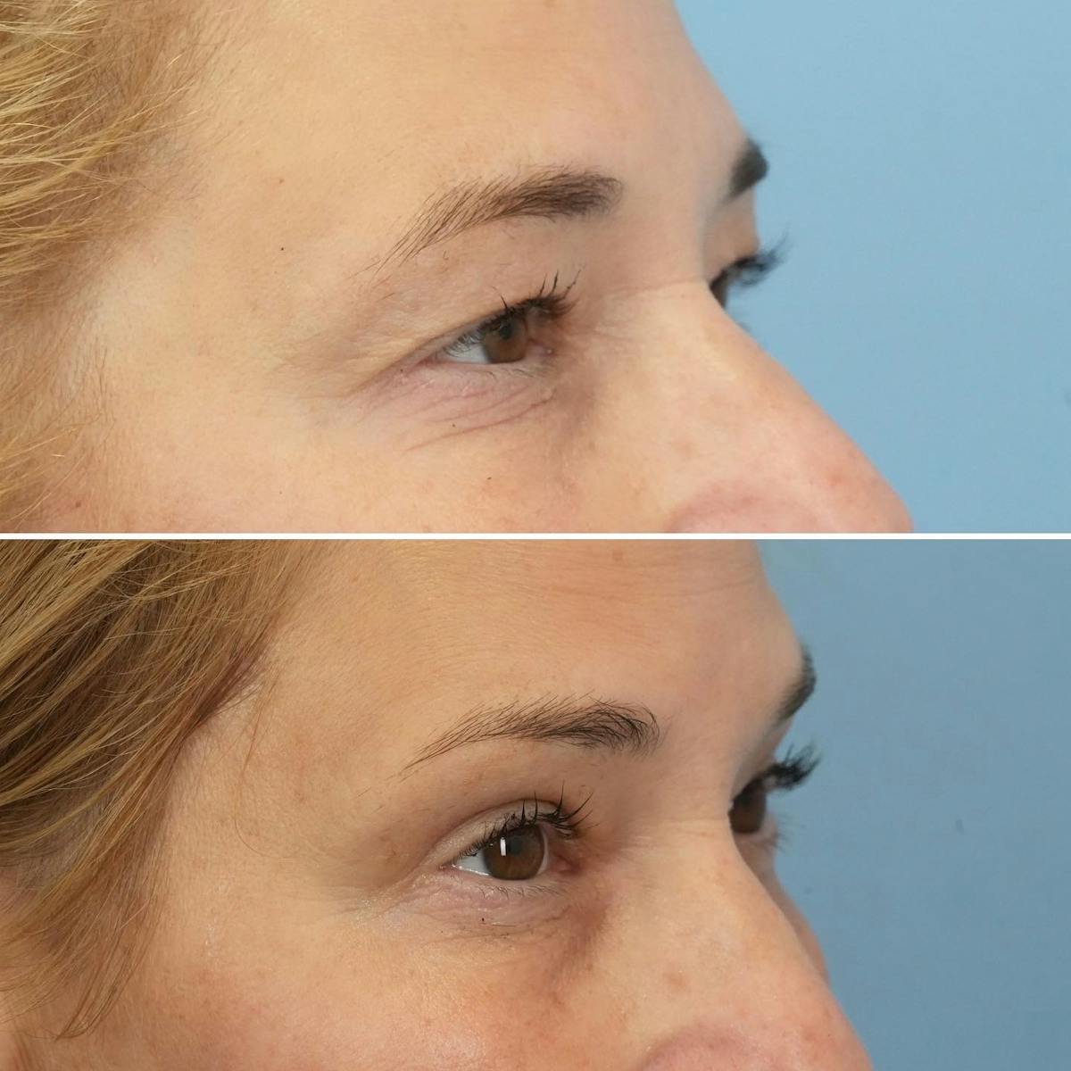 Blepharoplasty Before & After Gallery - Patient 259917 - Image 5