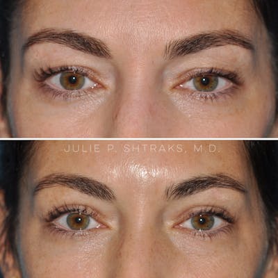 Blepharoplasty Before & After Gallery - Patient 349242 - Image 1