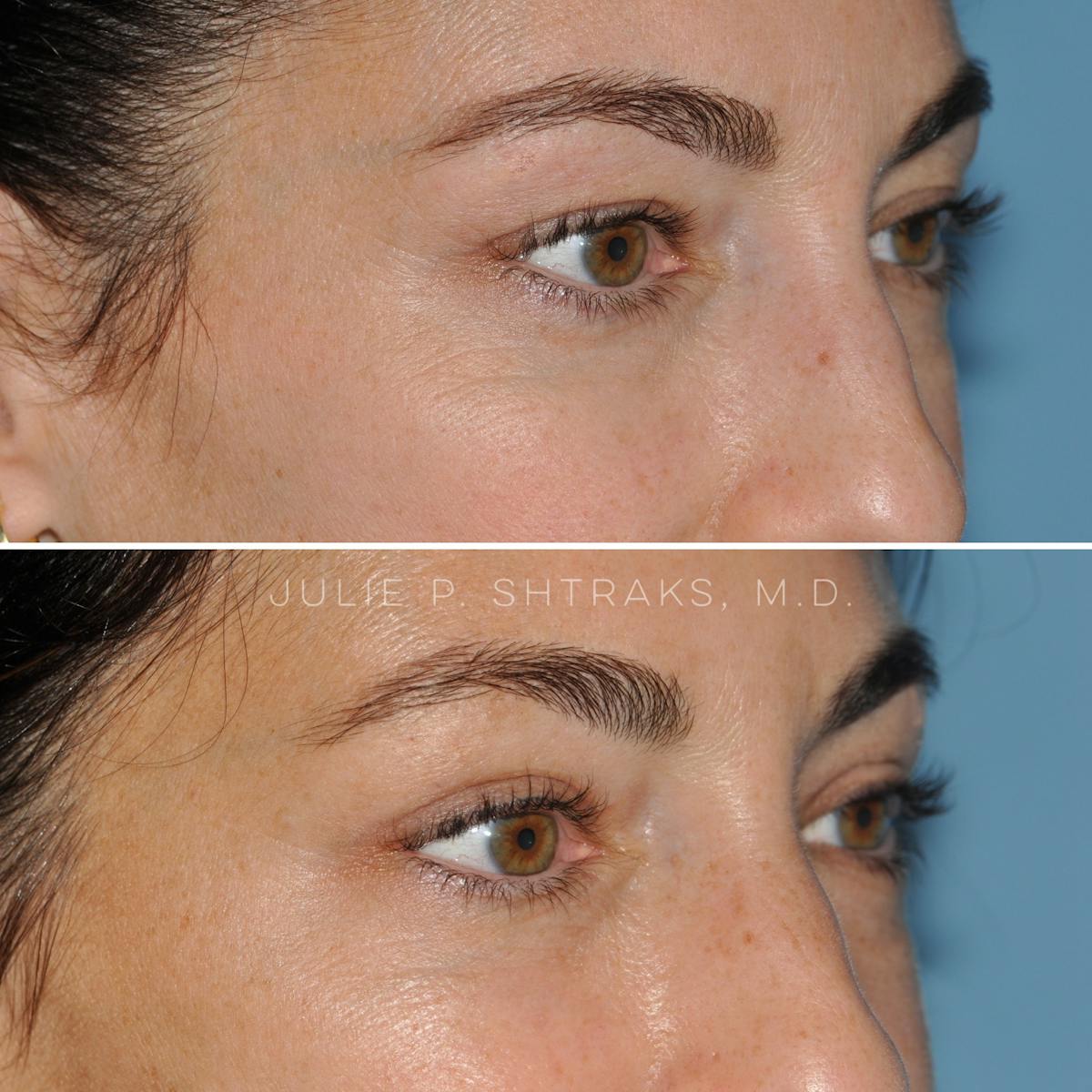 Blepharoplasty Before & After Gallery - Patient 349242 - Image 2