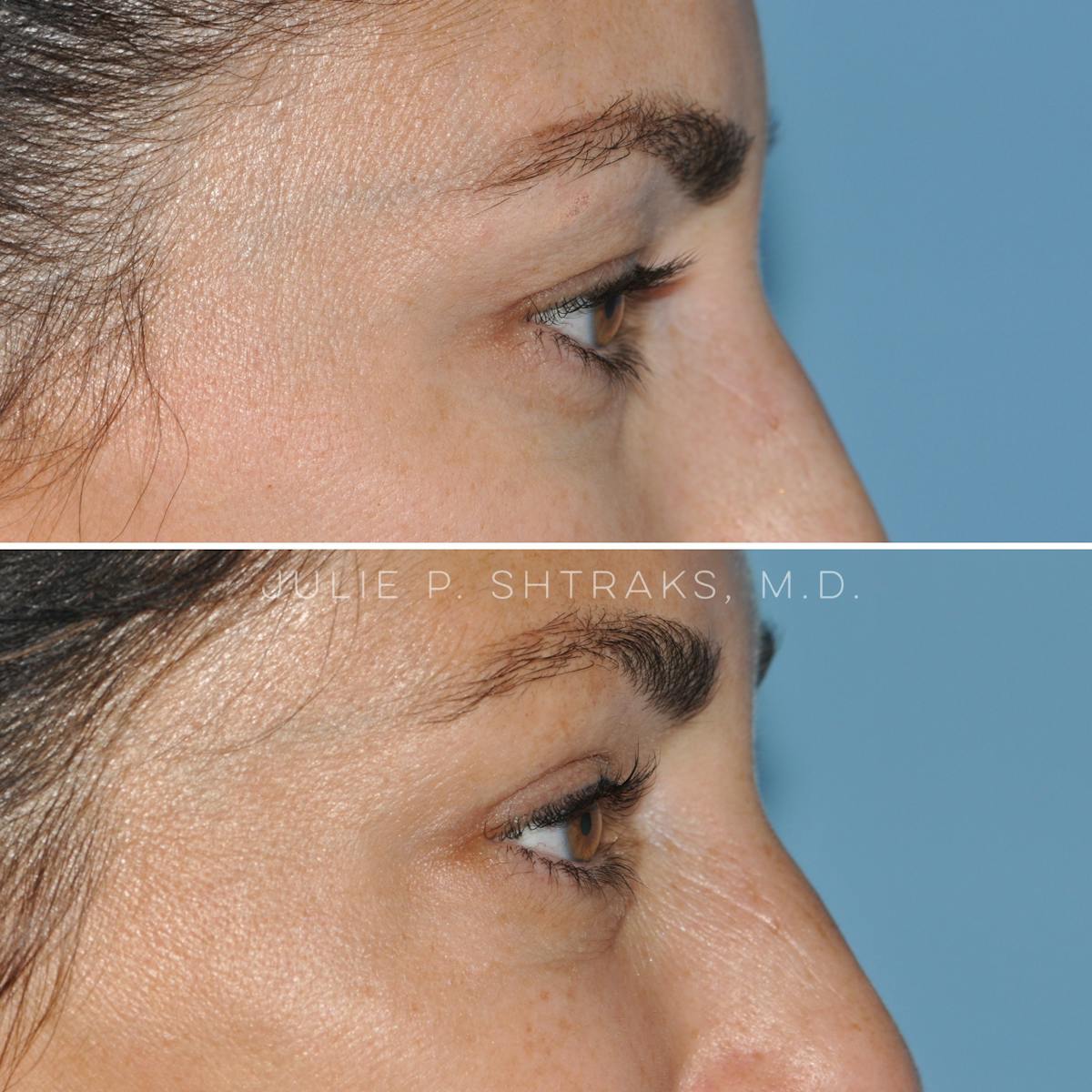 Blepharoplasty Before & After Gallery - Patient 349242 - Image 3