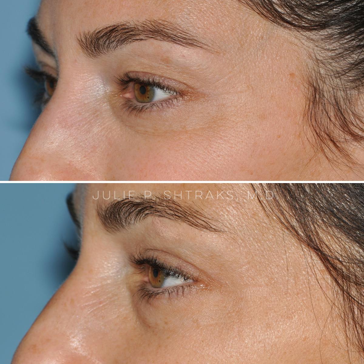Blepharoplasty Before & After Gallery - Patient 349242 - Image 4
