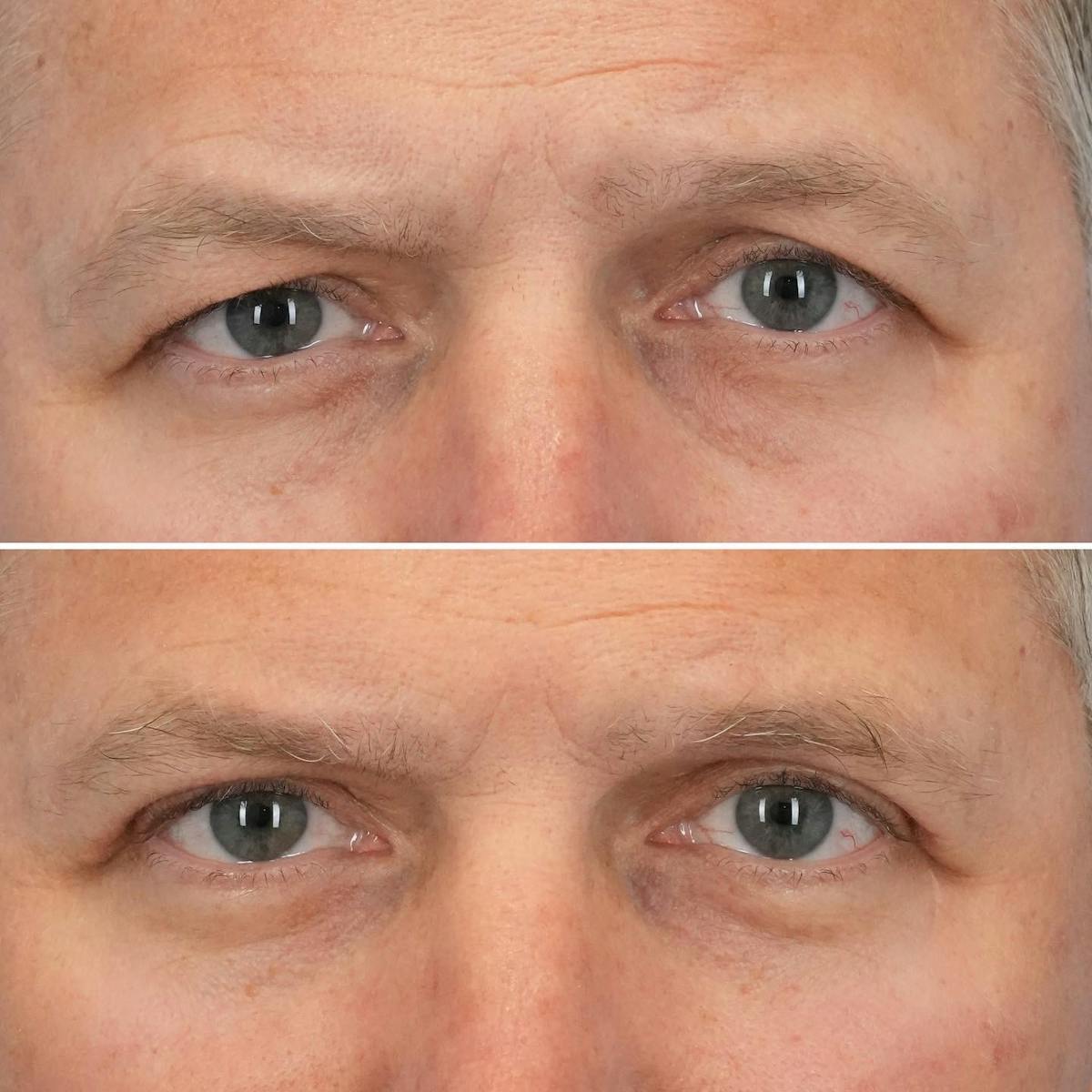 Blepharoplasty Before & After Gallery - Patient 302789 - Image 1