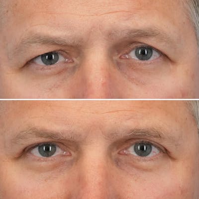 Blepharoplasty Before & After Gallery - Patient 302789 - Image 1