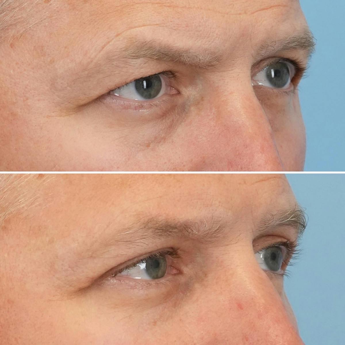 Blepharoplasty Before & After Gallery - Patient 302789 - Image 2
