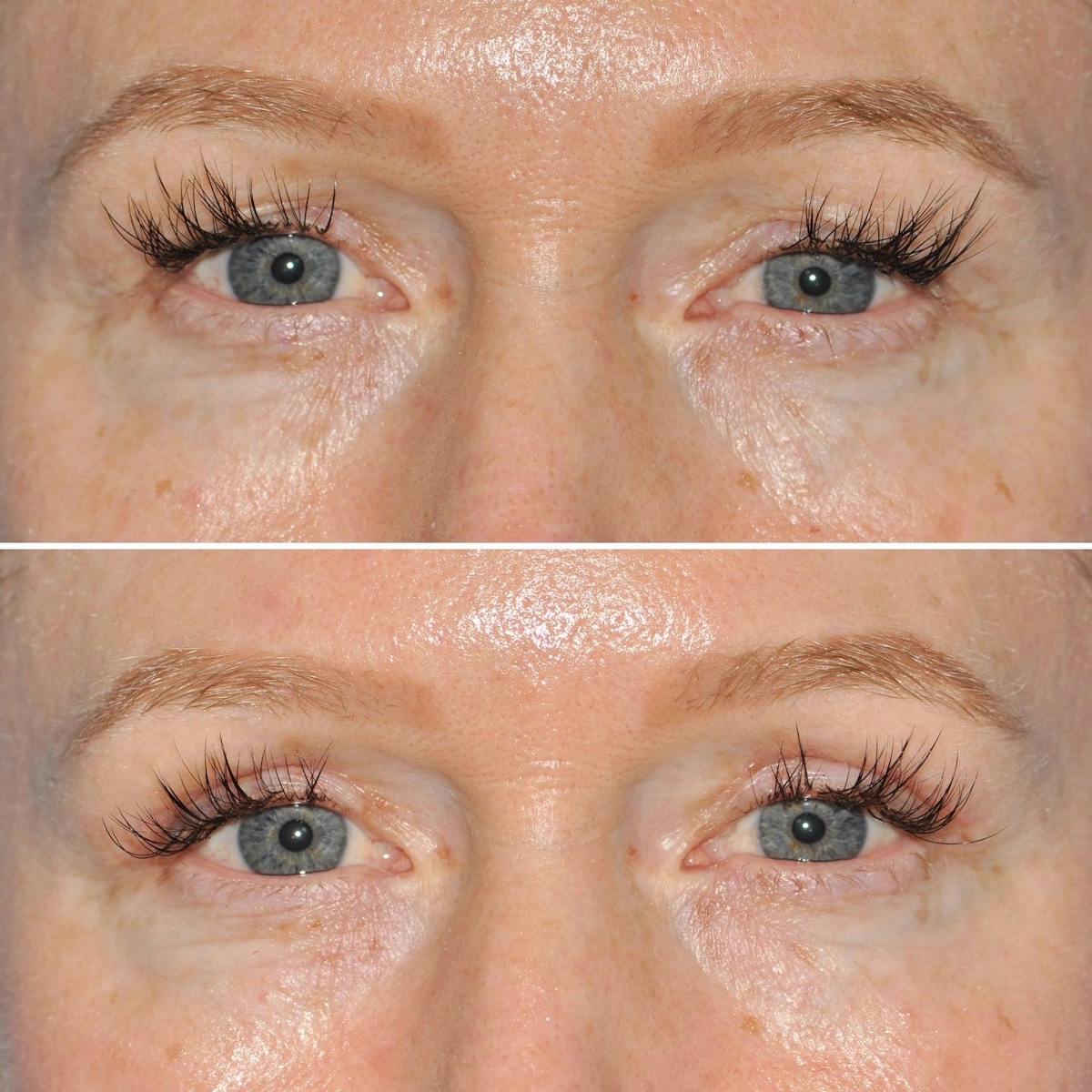 Blepharoplasty Before & After Gallery - Patient 157611 - Image 1