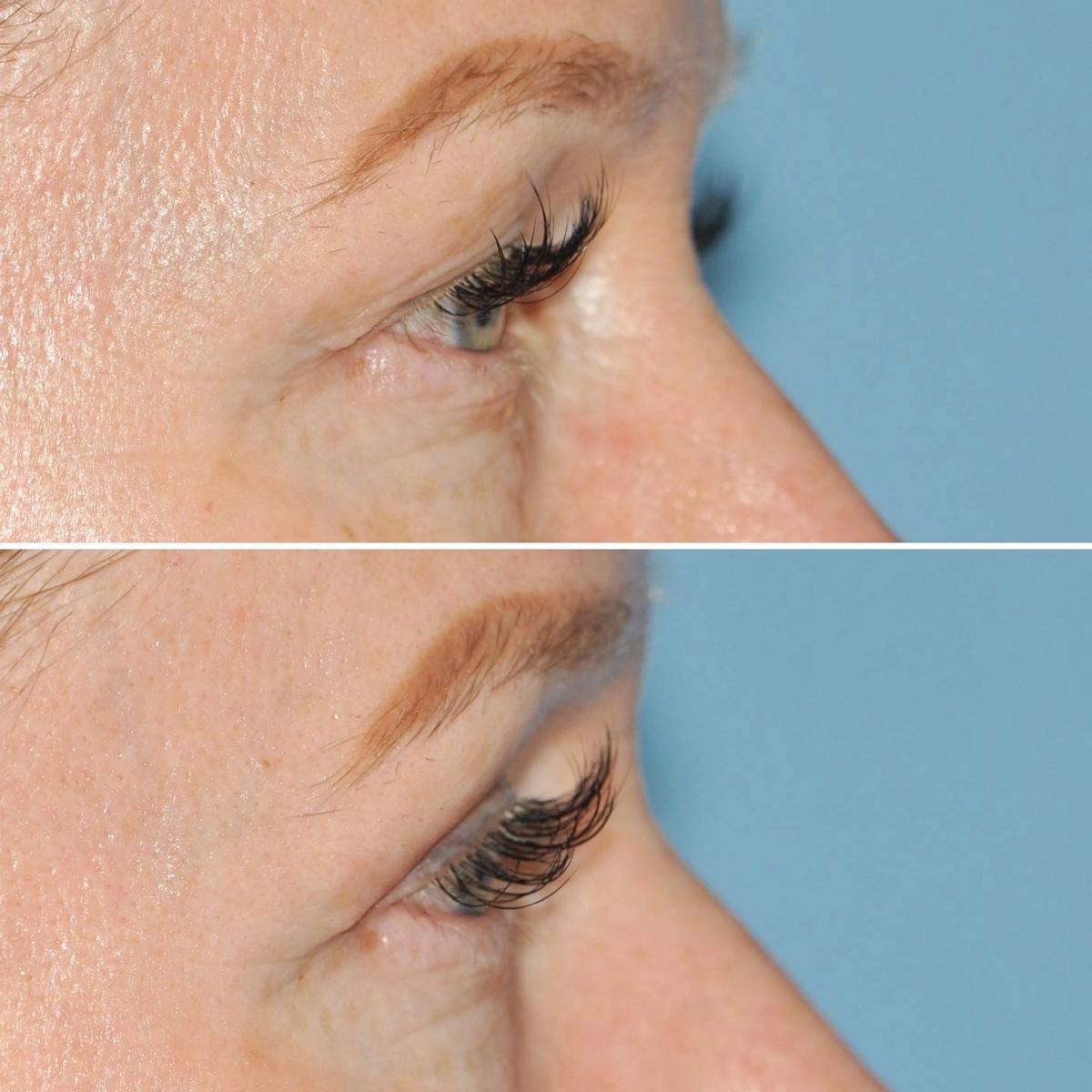 Blepharoplasty Before & After Gallery - Patient 157611 - Image 3