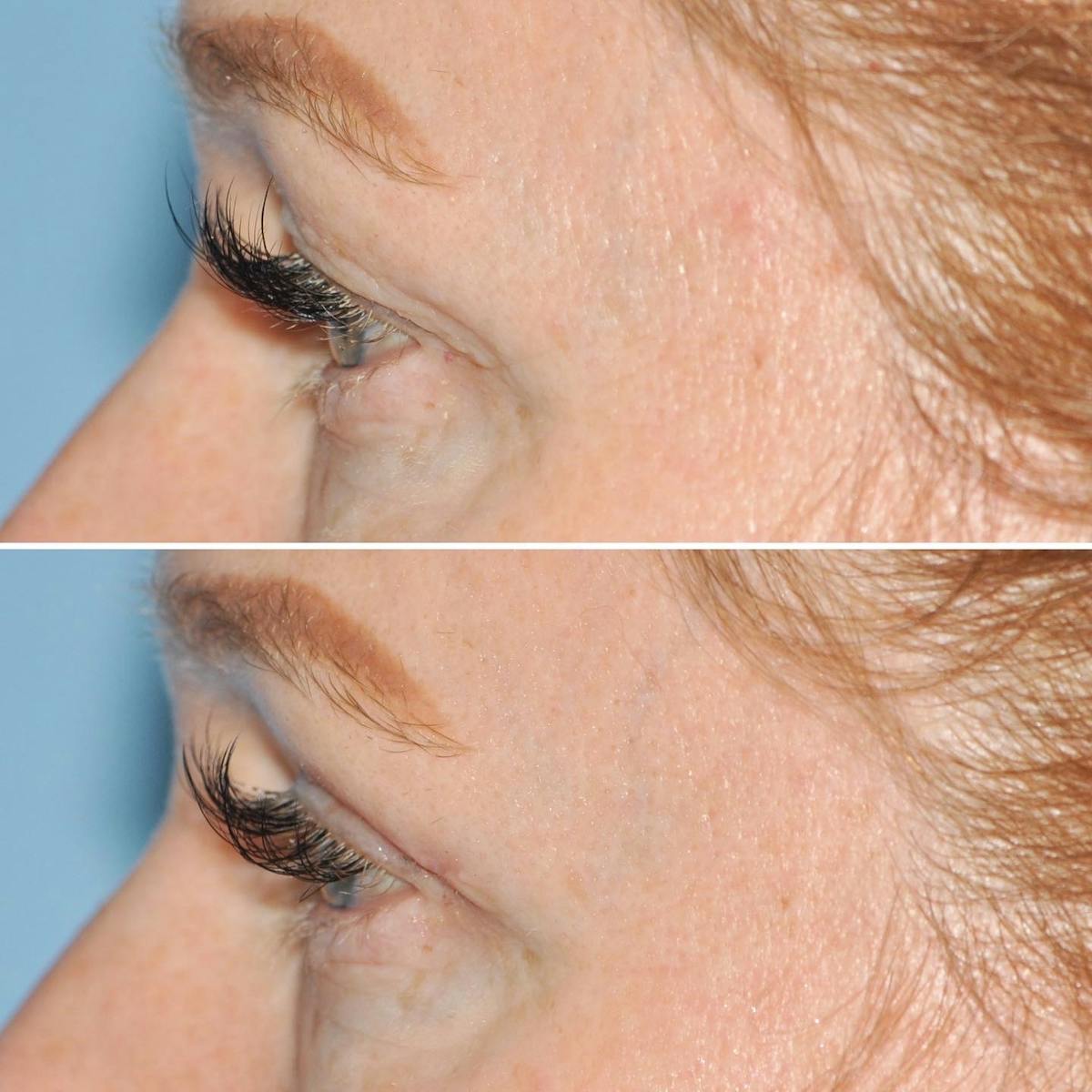 Blepharoplasty Before & After Gallery - Patient 157611 - Image 5
