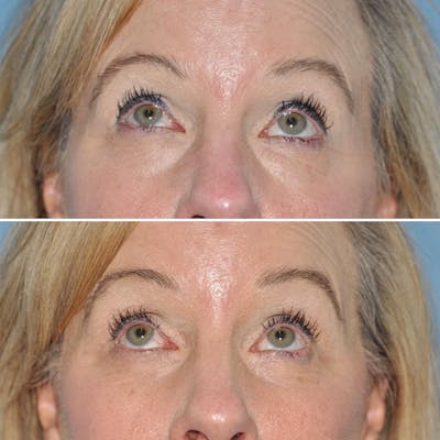 Blepharoplasty Before & After Gallery - Patient 341951 - Image 1