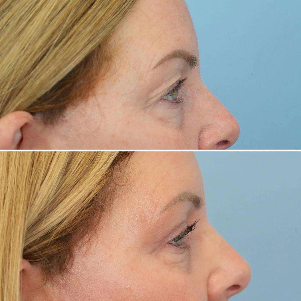 Blepharoplasty Before & After Gallery - Patient 418674 - Image 2