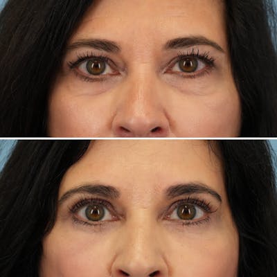 Blepharoplasty Before & After Gallery - Patient 102654 - Image 1