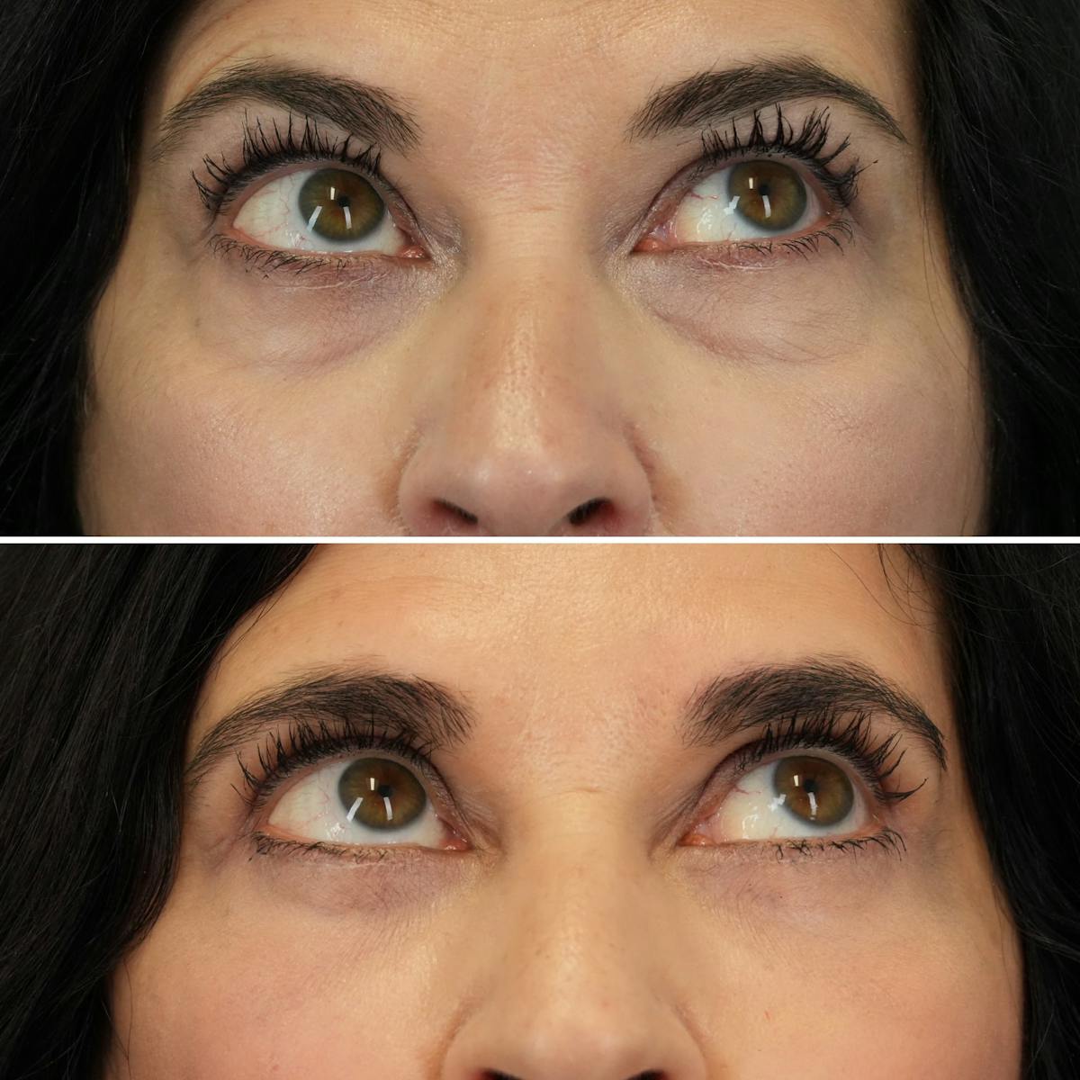 Blepharoplasty Before & After Gallery - Patient 102654 - Image 2