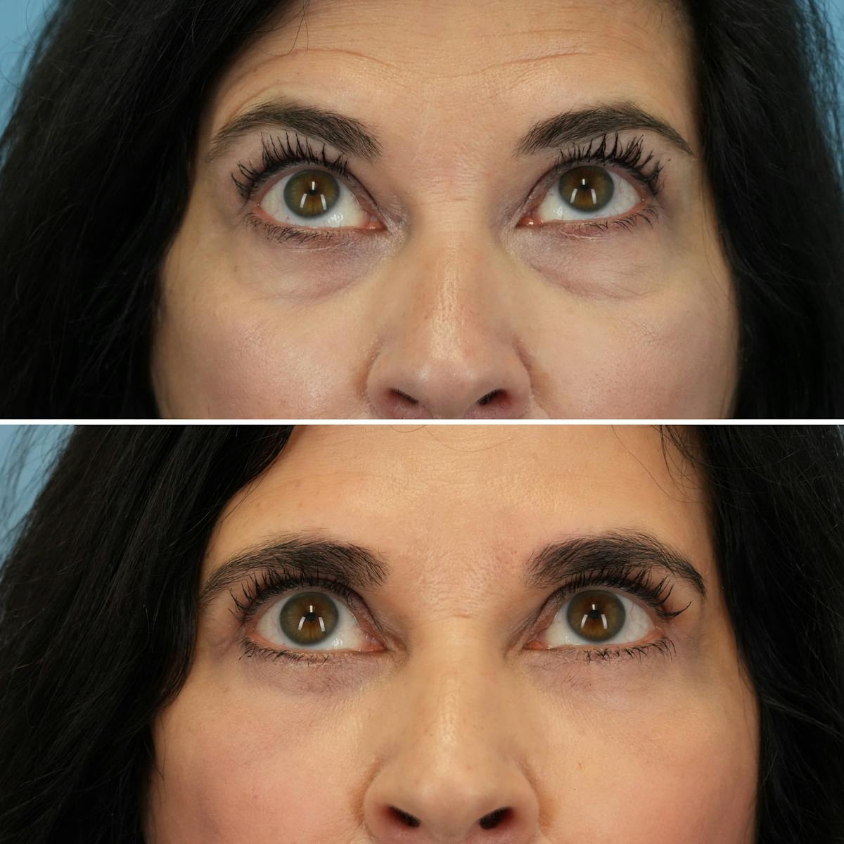 Blepharoplasty Before & After Gallery - Patient 102654 - Image 3