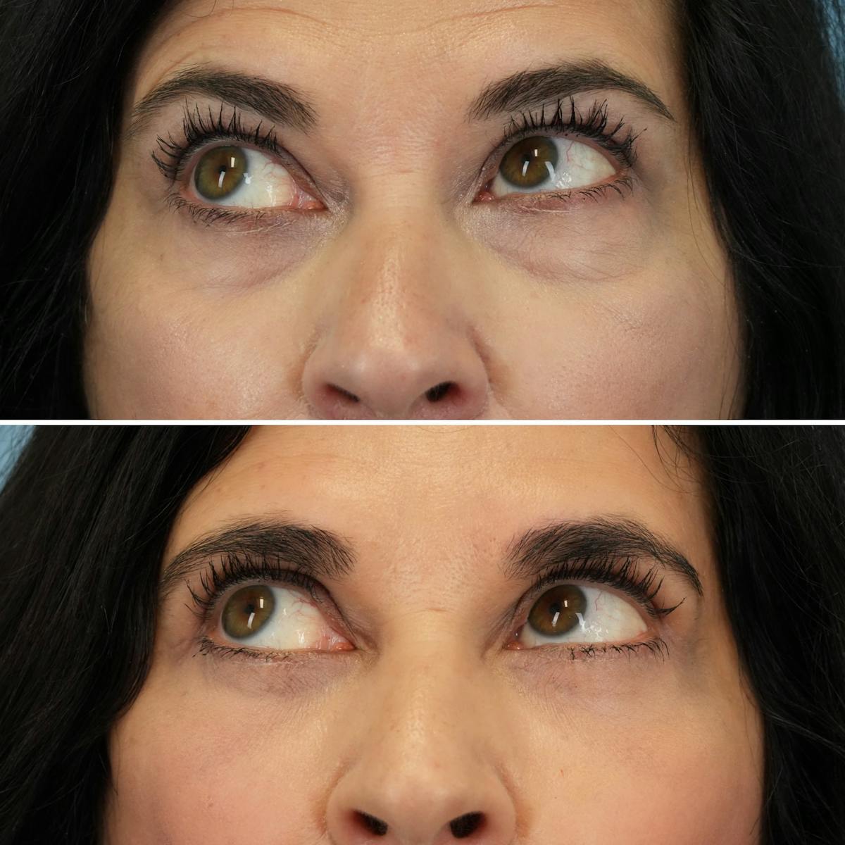 Blepharoplasty Before & After Gallery - Patient 102654 - Image 4