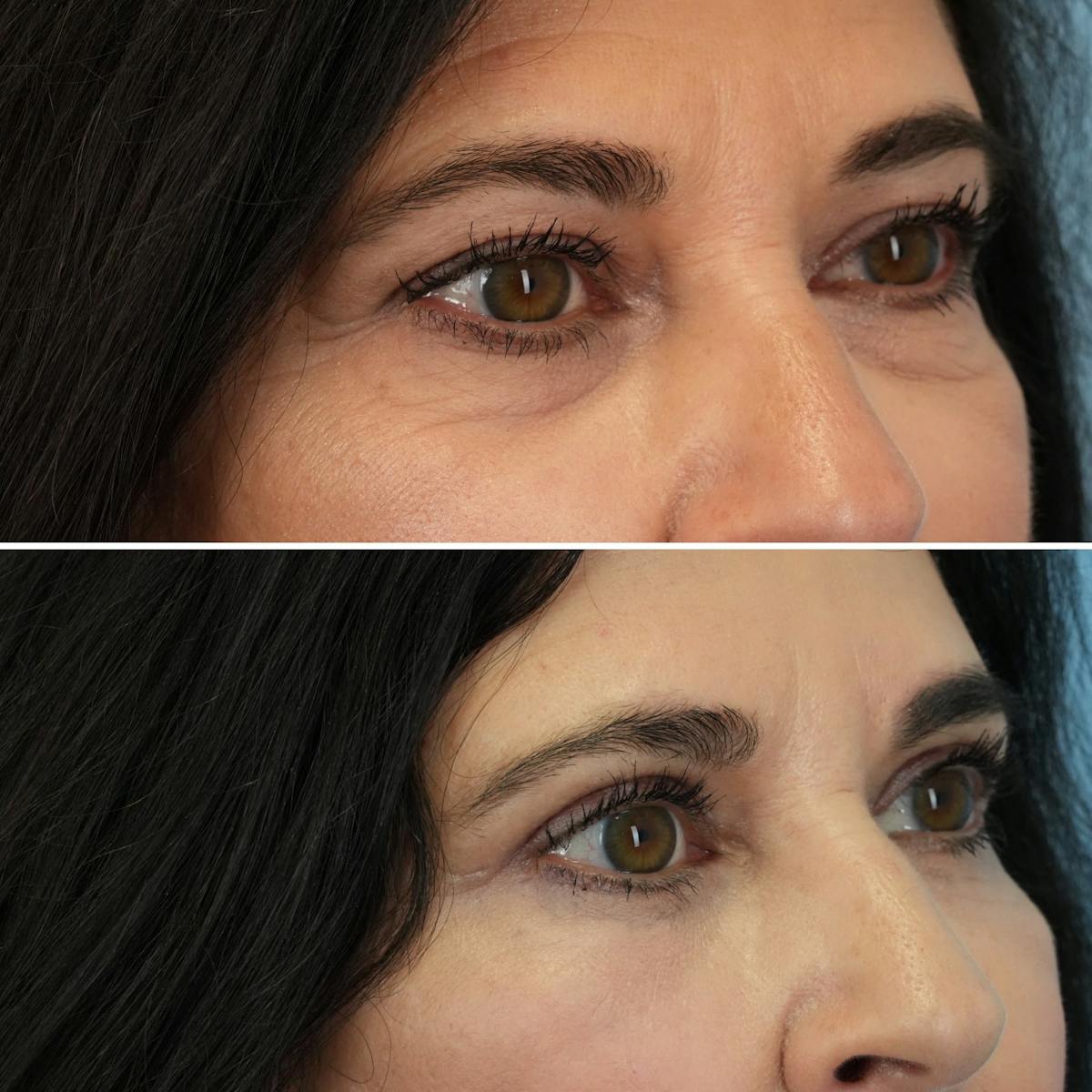 Blepharoplasty Before & After Gallery - Patient 102654 - Image 5
