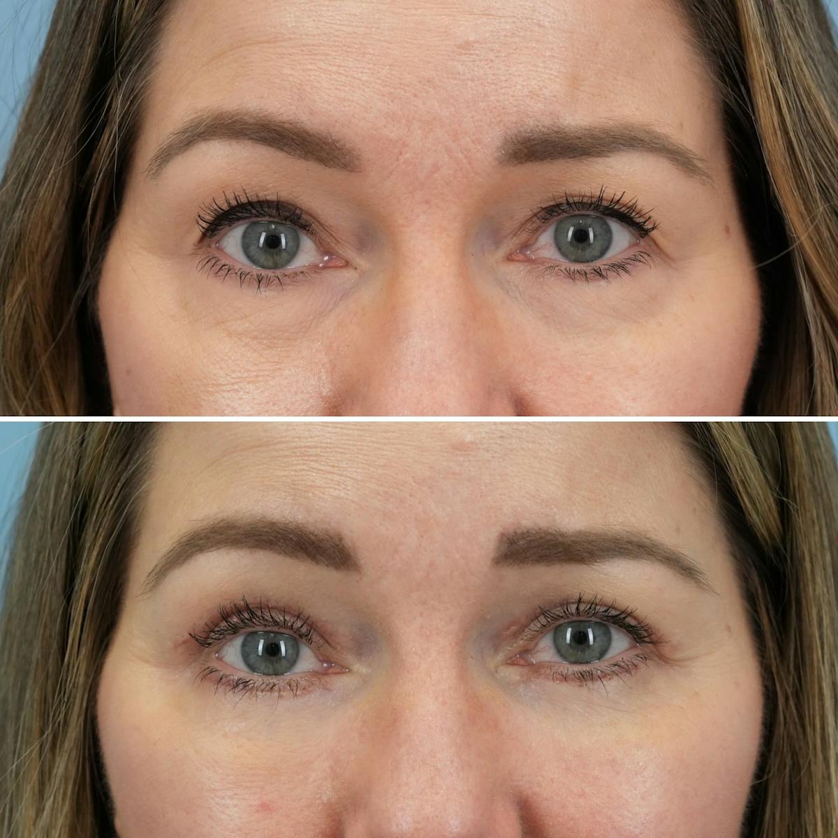 Blepharoplasty Before & After Gallery - Patient 960626 - Image 1