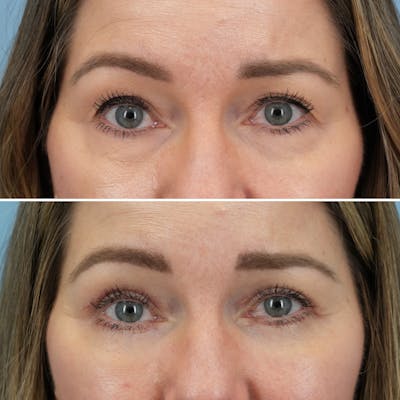 Blepharoplasty Before & After Gallery - Patient 960626 - Image 1