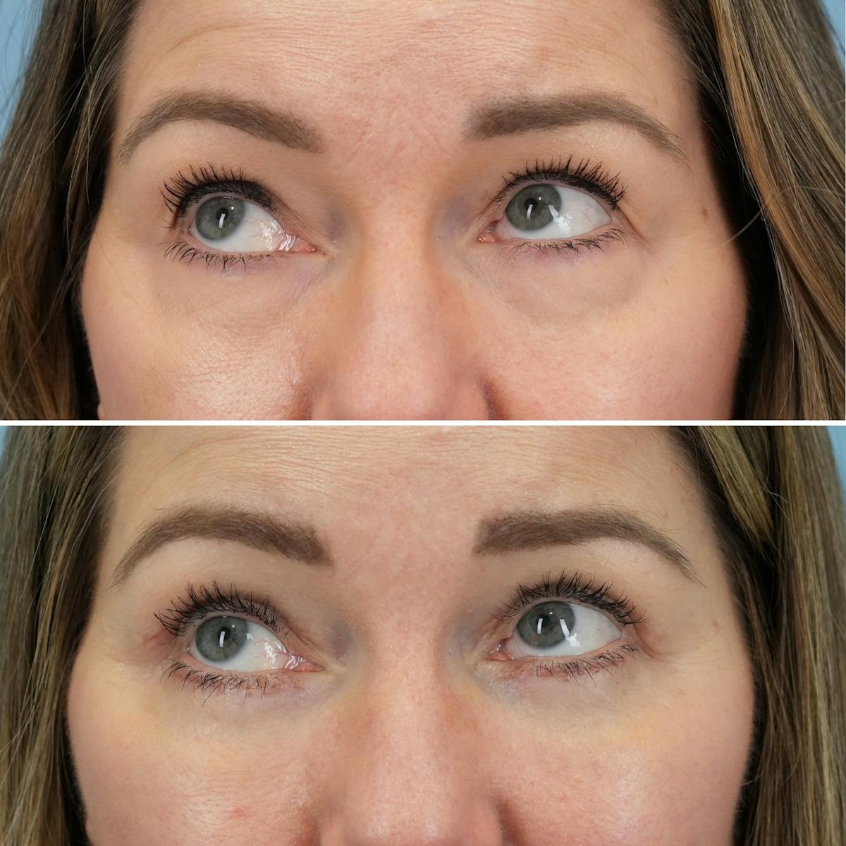 Blepharoplasty Before & After Gallery - Patient 960626 - Image 2