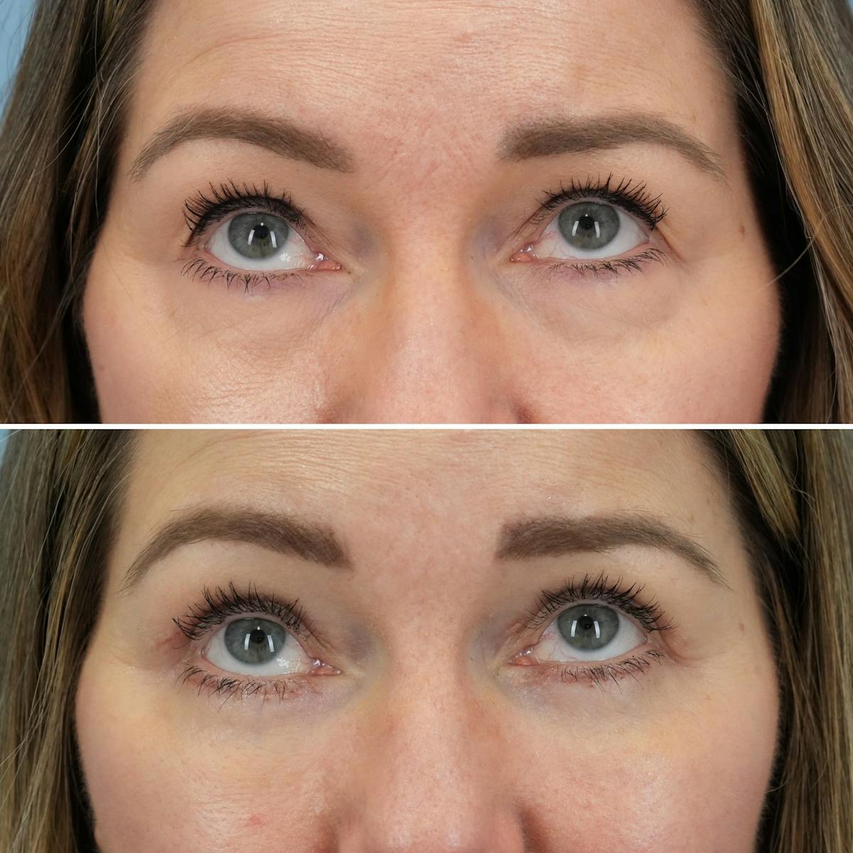 Blepharoplasty Before & After Gallery - Patient 960626 - Image 3