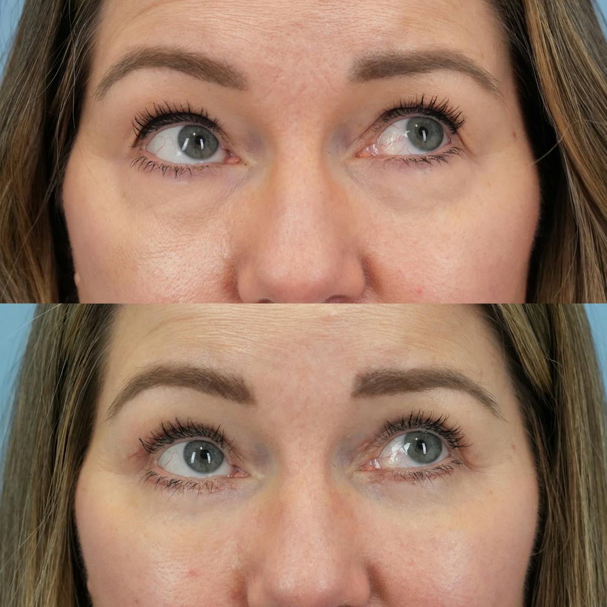 Blepharoplasty Before & After Gallery - Patient 960626 - Image 4