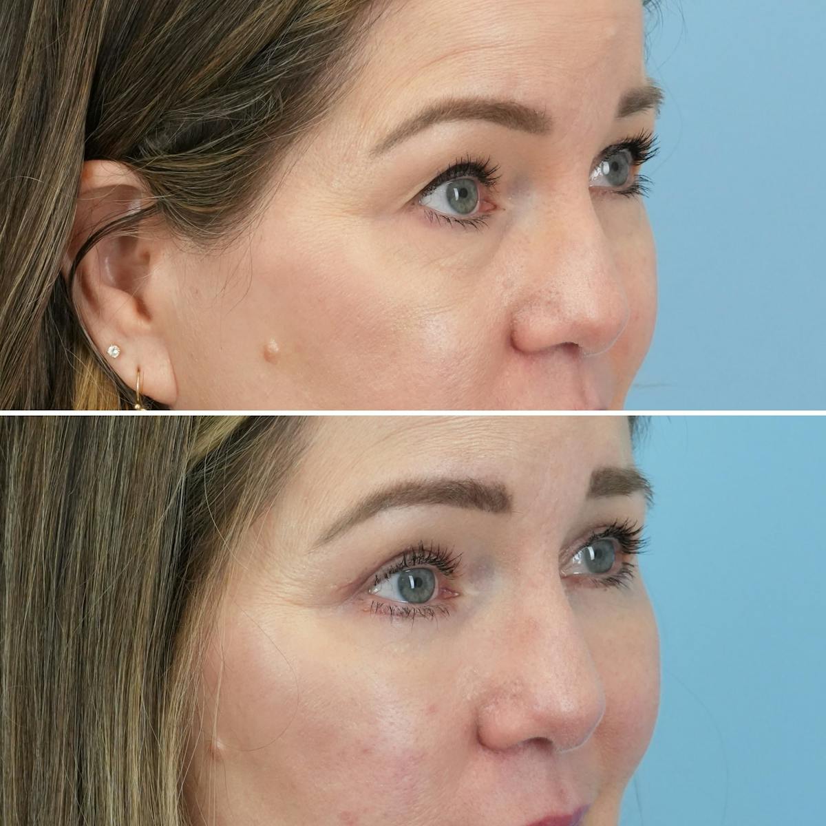 Blepharoplasty Before & After Gallery - Patient 960626 - Image 5