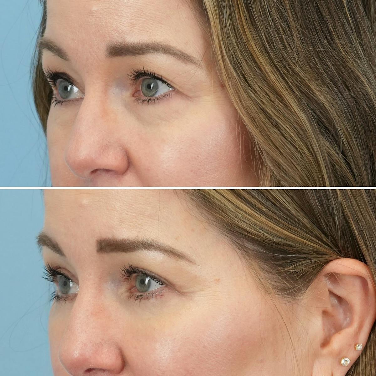 Blepharoplasty Before & After Gallery - Patient 960626 - Image 6