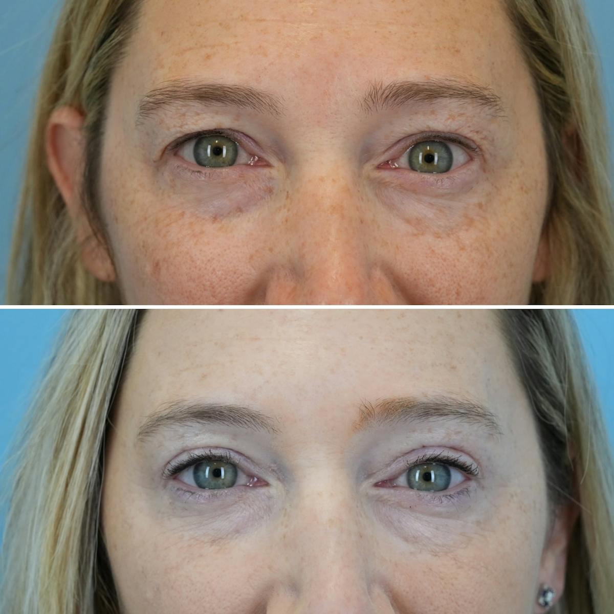 Blepharoplasty Before & After Gallery - Patient 535682 - Image 1