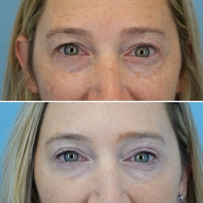 Blepharoplasty Before & After Gallery - Patient 535682 - Image 1