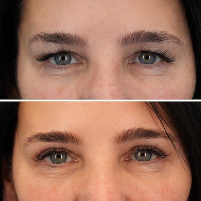 Blepharoplasty Before & After Gallery - Patient 364877 - Image 1