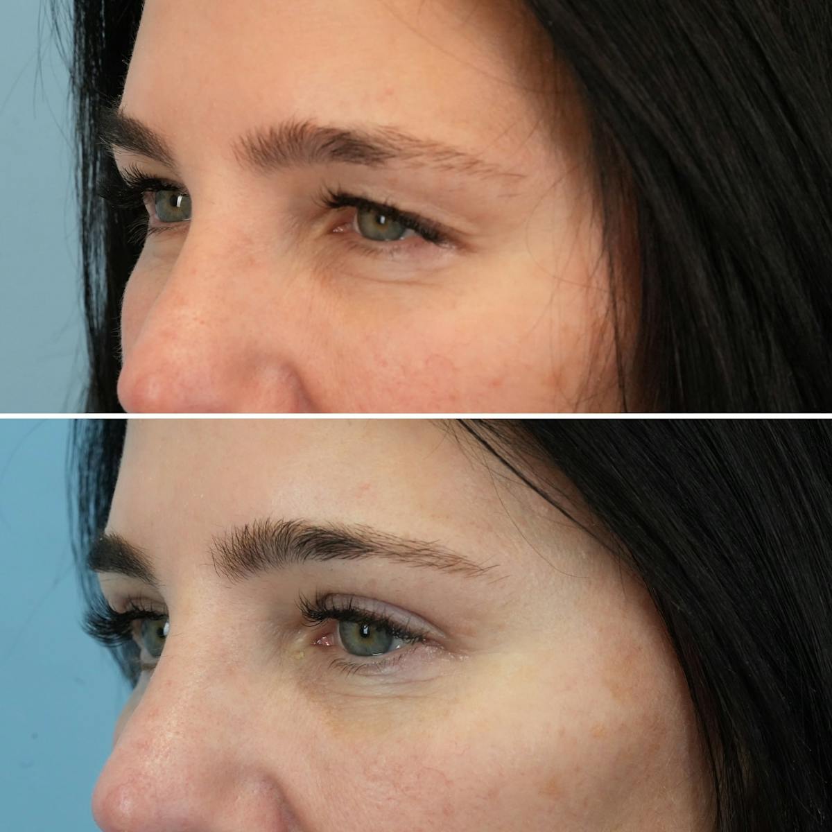 Blepharoplasty Before & After Gallery - Patient 364877 - Image 2