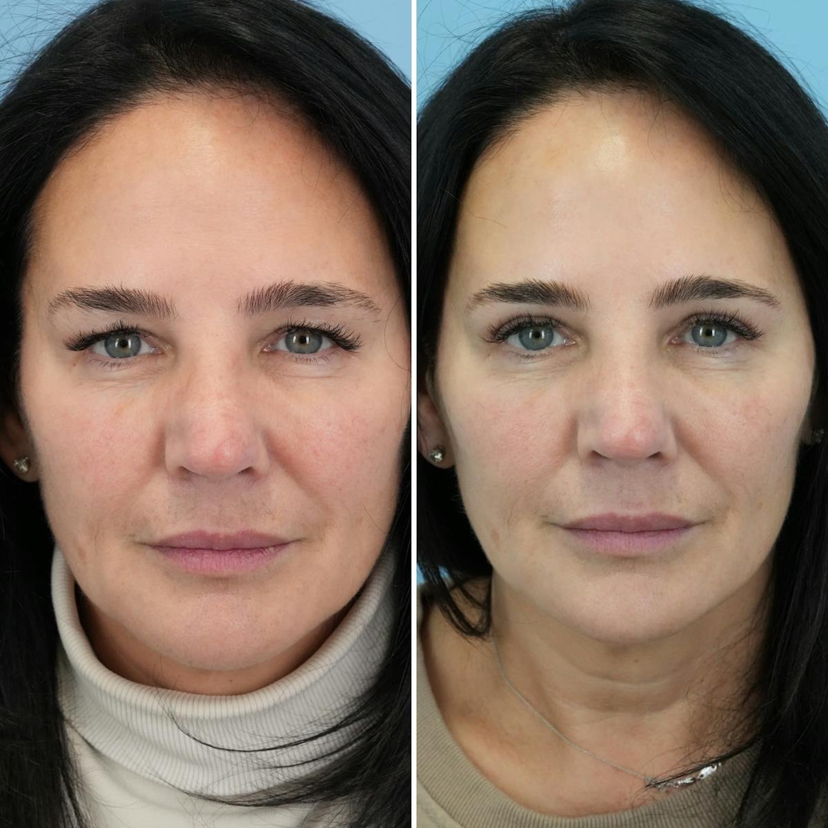 Blepharoplasty Before & After Gallery - Patient 364877 - Image 3