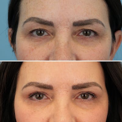 Blepharoplasty Before & After Gallery - Patient 399438 - Image 1